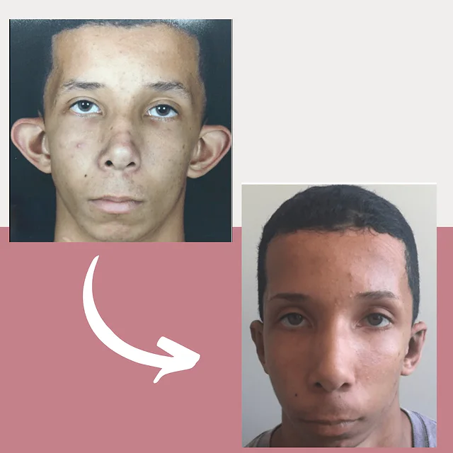 Caso fotográfico de Otoplastia, imagen comparativa 2