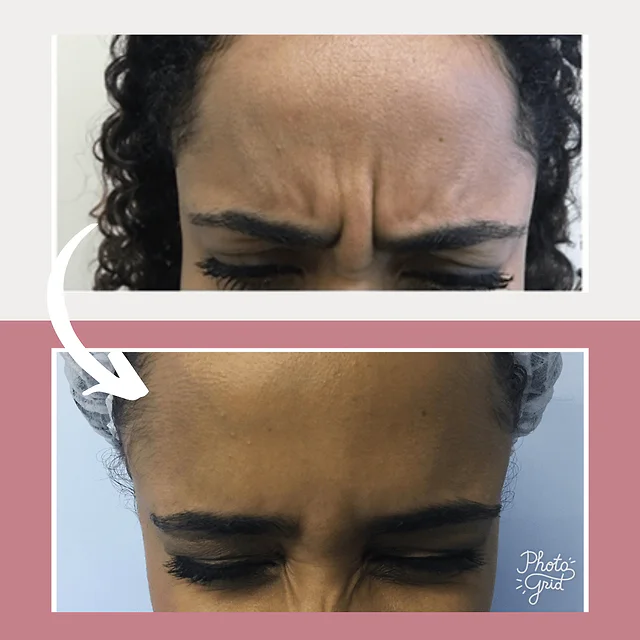 Caso fotográfico de Toxina Botulínica, imagen comparativa 1