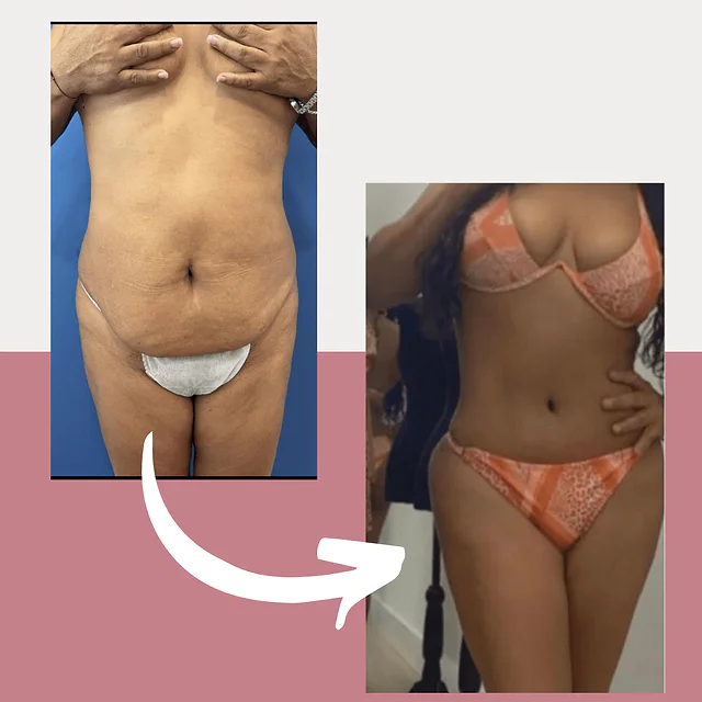 Caso fotográfico de Abdominoplastia, imagen comparativa 24