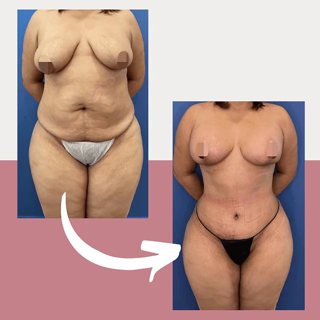 Caso fotográfico de Abdominoplastia, imagen comparativa 25