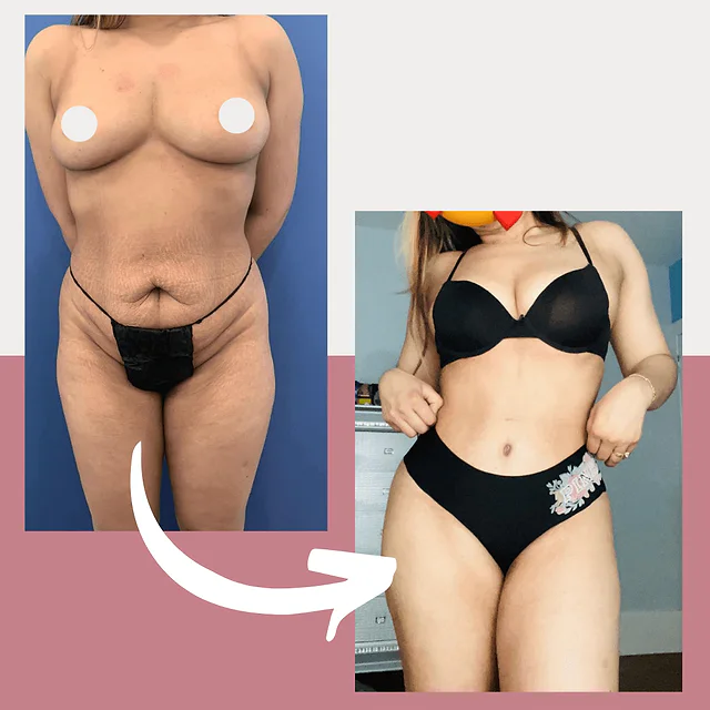 Caso fotográfico de Abdominoplastia, imagen comparativa 26