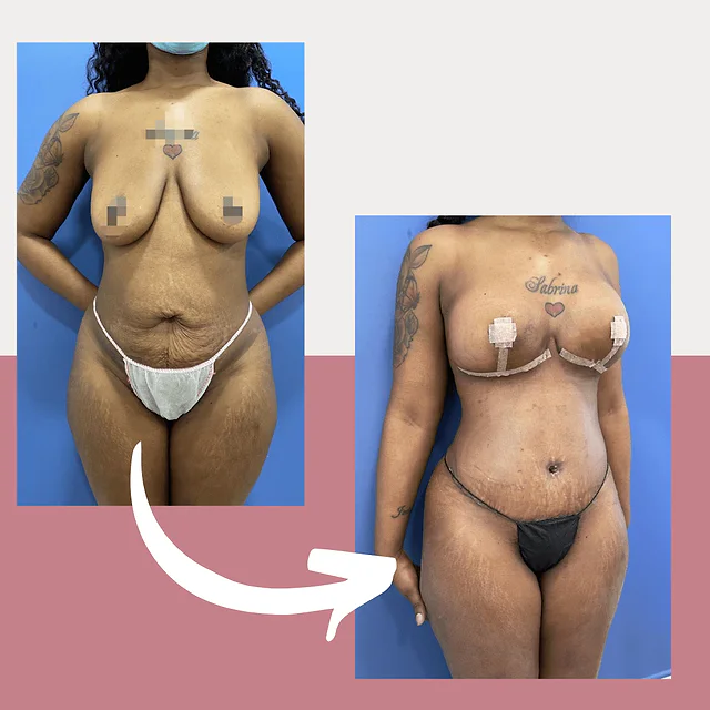 Caso fotográfico de Abdominoplastia, imagen comparativa 27