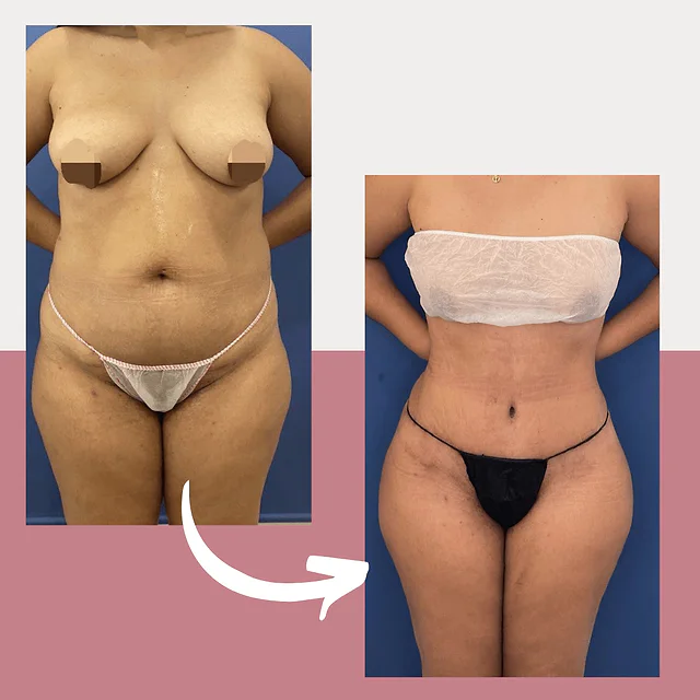 Caso fotográfico de Abdominoplastia, imagen comparativa 28