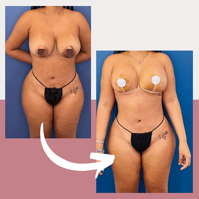 Caso fotográfico de Levantamiento Mamario, imagen comparativa 10