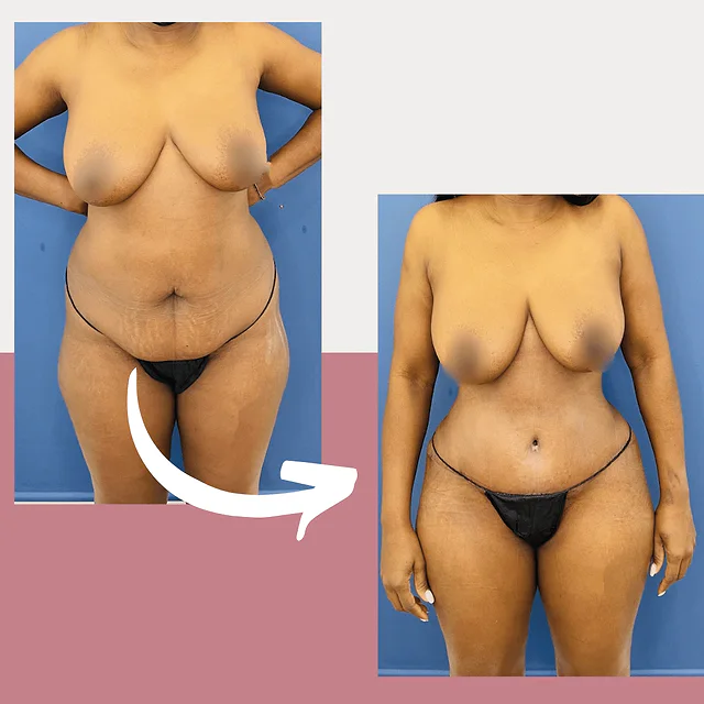 Caso fotográfico de Abdominoplastia, imagen comparativa 11