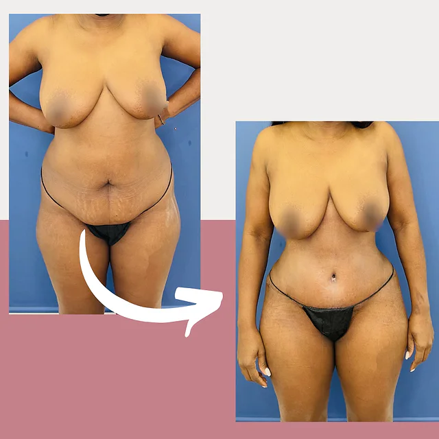 Caso fotográfico de Abdominoplastia, imagen comparativa 23