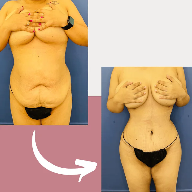 Caso fotográfico de Abdominoplastia, imagen comparativa 20