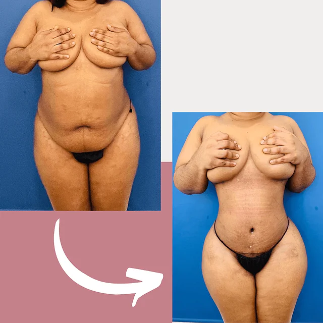 Caso fotográfico de Abdominoplastia, imagen comparativa 21