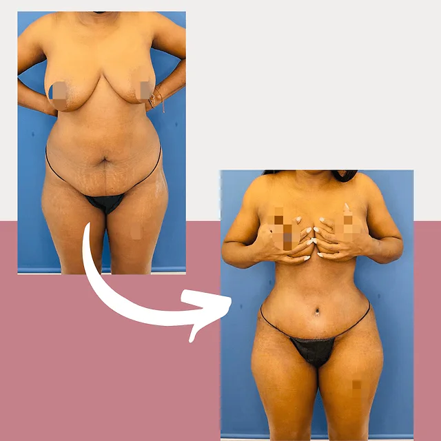 Caso fotográfico de Abdominoplastia, imagen comparativa 22