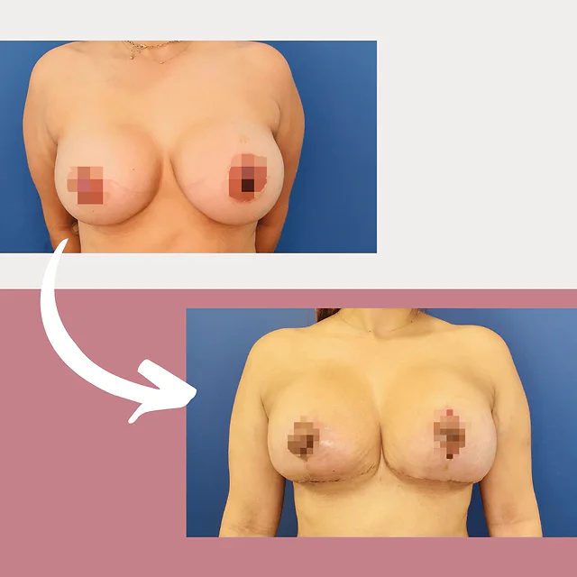 Caso fotográfico de Levantamiento Mamario, imagen comparativa 9