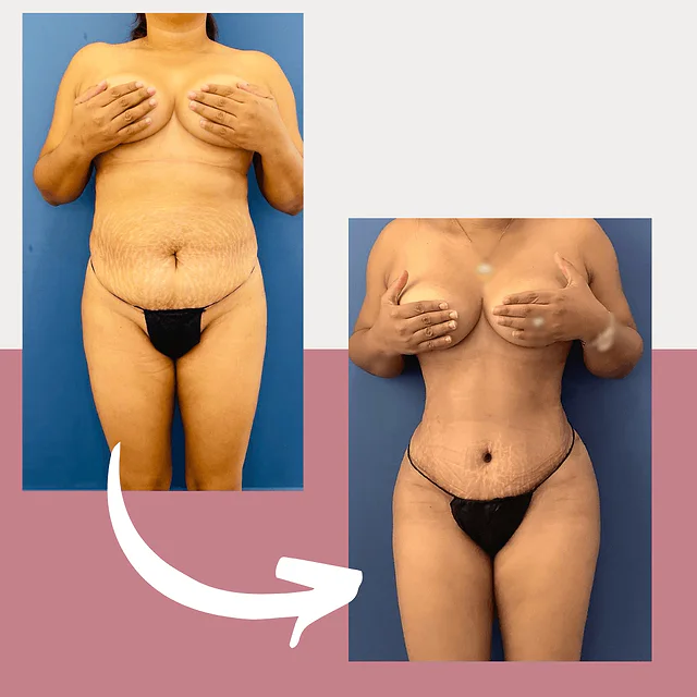 Caso fotográfico de Abdominoplastia, imagen comparativa 19