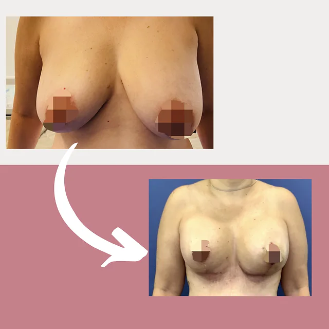 Caso fotográfico de Levantamiento Mamario, imagen comparativa 8