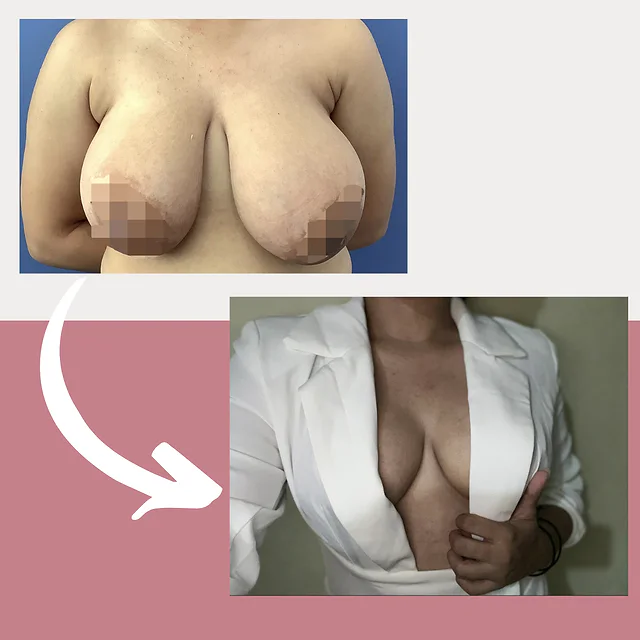 Caso fotográfico de Reducción Mamaria, imagen comparativa 1