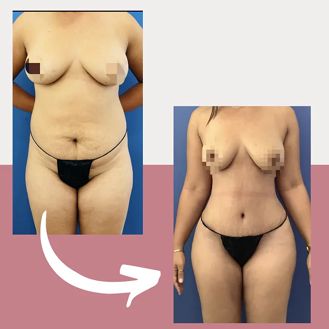 Caso fotográfico de Abdominoplastia, imagen comparativa 18