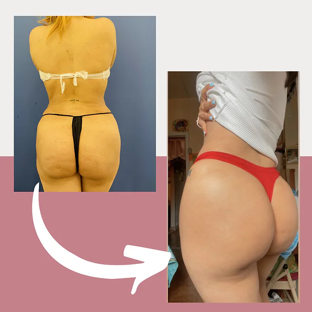 Caso fotográfico de Levantamiento de Glúteos Brasileño, imagen comparativa 4