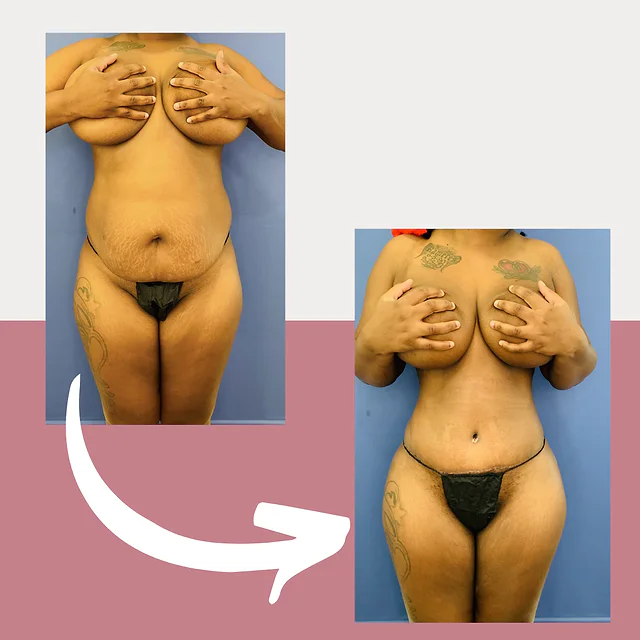 Caso fotográfico de Abdominoplastia, imagen comparativa 17