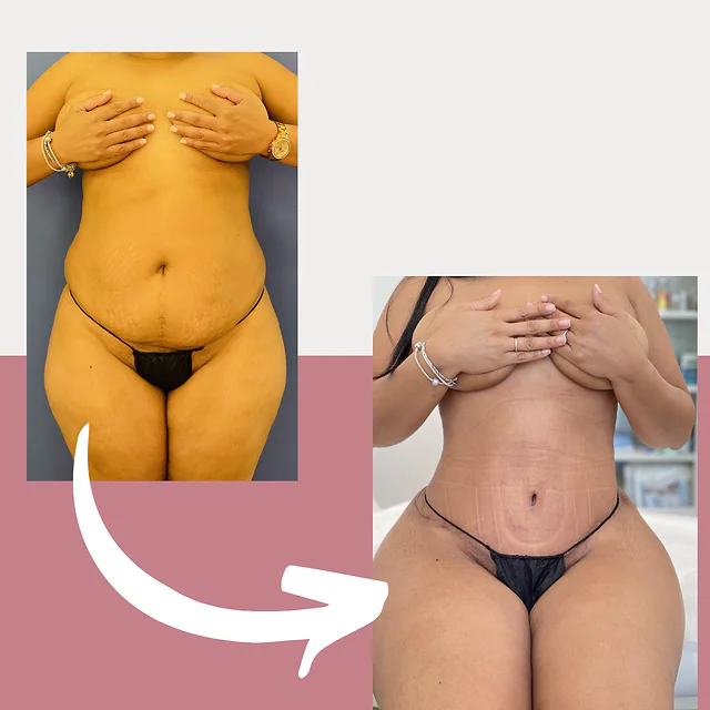 Caso fotográfico de Abdominoplastia, imagen comparativa 16