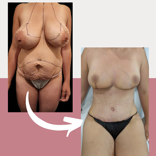 Caso fotográfico de Abdominoplastia, imagen comparativa 12