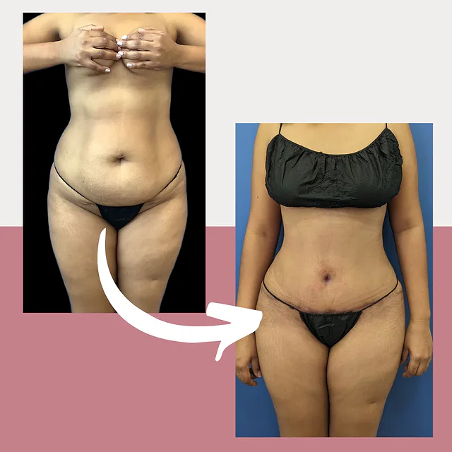 Caso fotográfico de Abdominoplastia, imagen comparativa 13