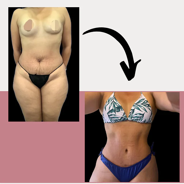 Caso fotográfico de Abdominoplastia, imagen comparativa 14