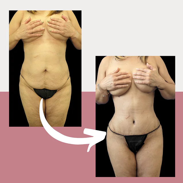 Caso fotográfico de Abdominoplastia, imagen comparativa 15