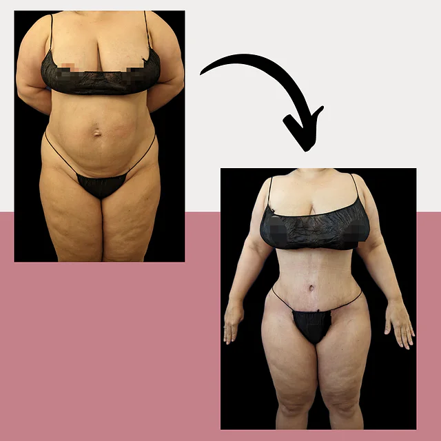 Caso fotográfico de Abdominoplastia, imagen comparativa 10