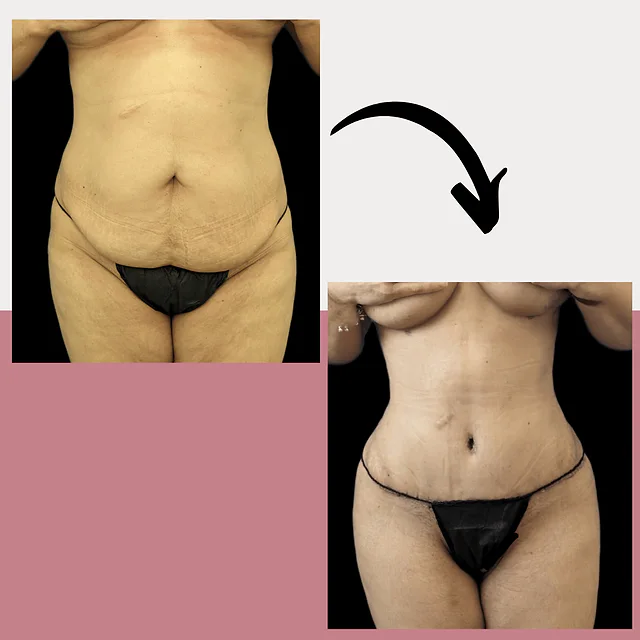 Caso fotográfico de Abdominoplastia, imagen comparativa 7