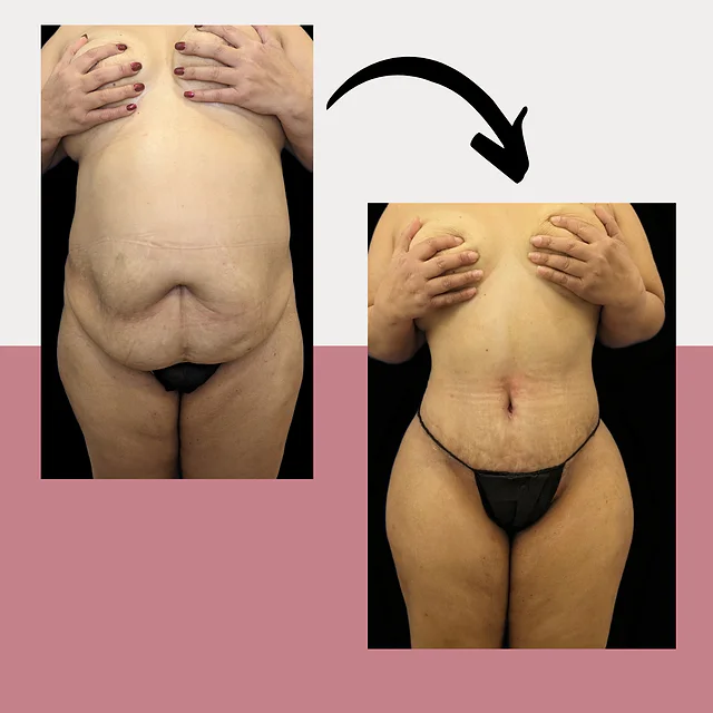 Caso fotográfico de Abdominoplastia, imagen comparativa 8