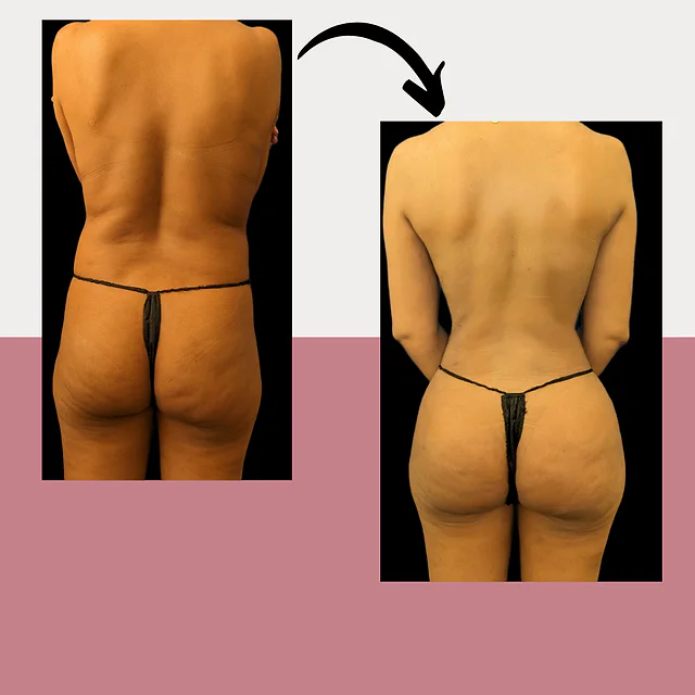 Caso fotográfico de Levantamiento de Glúteos Brasileño, imagen comparativa 2