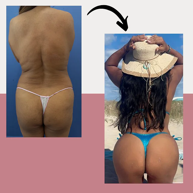 Caso fotográfico de Levantamiento de Glúteos Brasileño, imagen comparativa 3