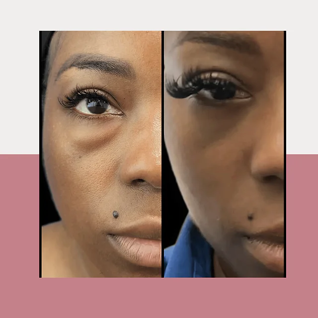 Caso fotográfico de Blefaroplastia, imagen comparativa 5