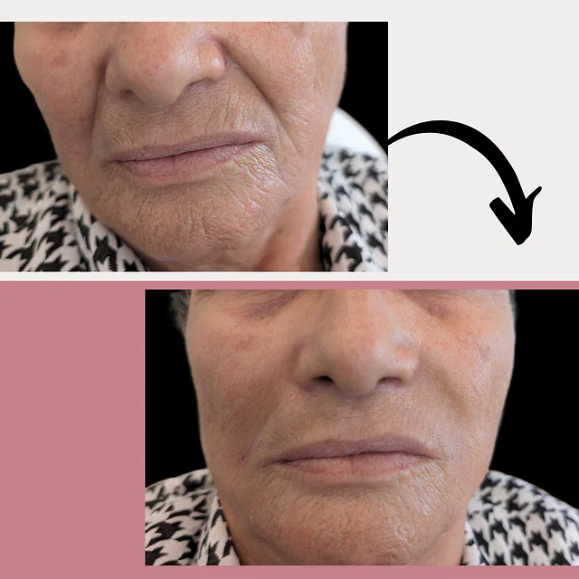 Caso fotográfico de Rellenos Faciales, imagen comparativa 3