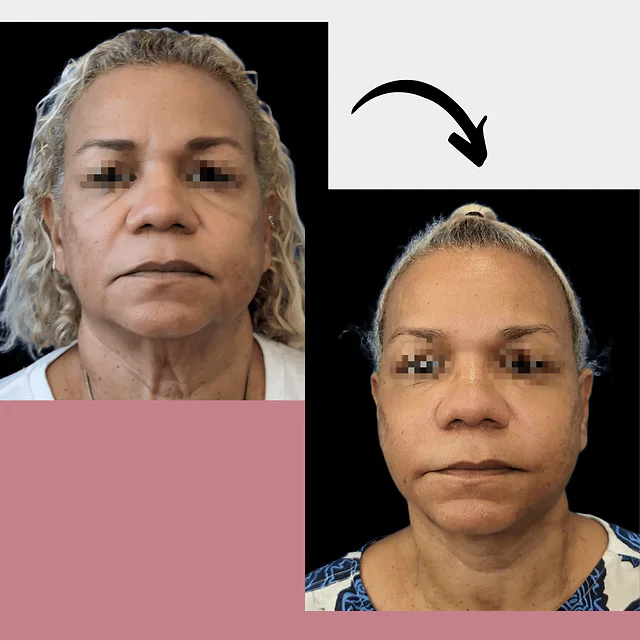Caso fotográfico de Lifting Facial, imagen comparativa 3
