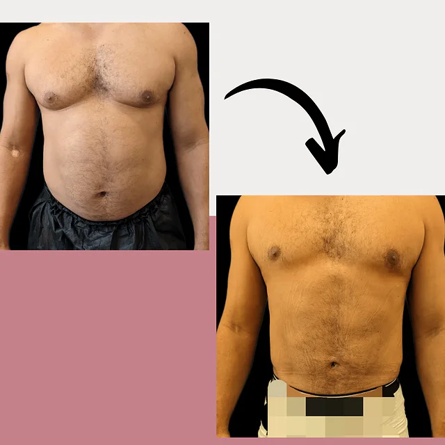 Caso fotográfico de Lipoescultura, imagen comparativa 2
