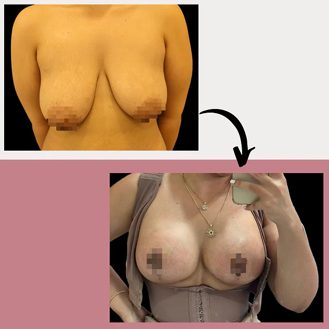 Caso fotográfico de Levantamiento Mamario, imagen comparativa 5