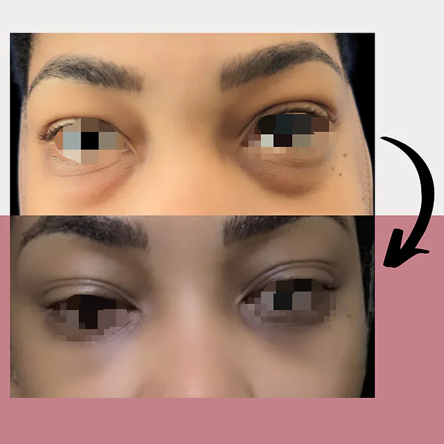 Caso fotográfico de Blefaroplastia, imagen comparativa 4
