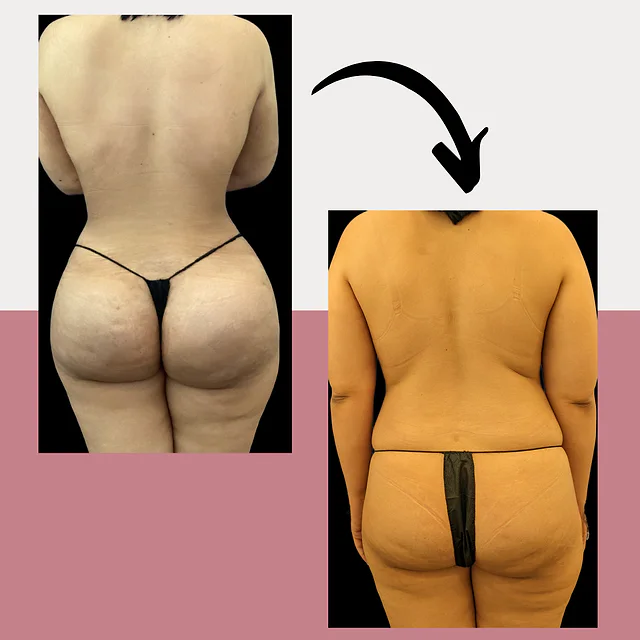 Caso fotográfico de Levantamiento de Glúteos Brasileño, imagen comparativa 1