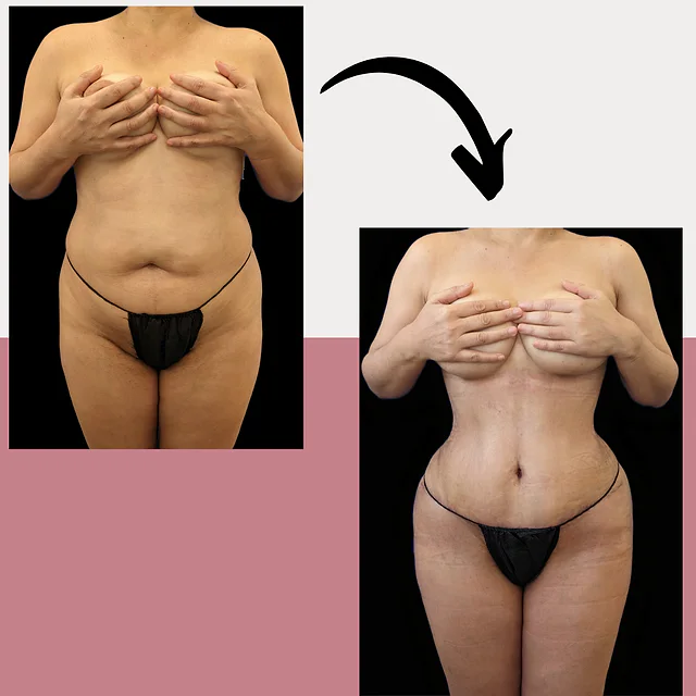 Caso fotográfico de Abdominoplastia, imagen comparativa 6