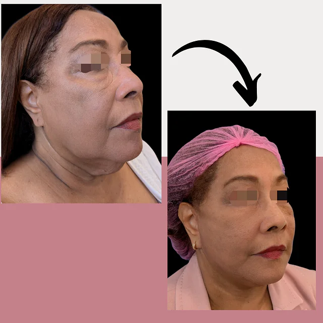 Caso fotográfico de Lifting Facial, imagen comparativa 2