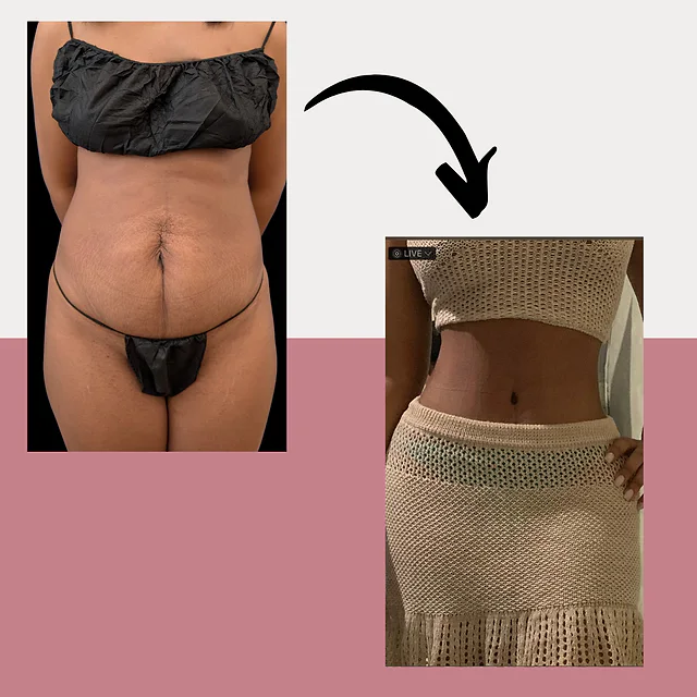 Caso fotográfico de Abdominoplastia, imagen comparativa 5