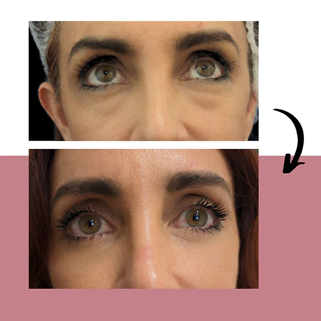 Caso fotográfico de Blefaroplastia, imagen comparativa 2