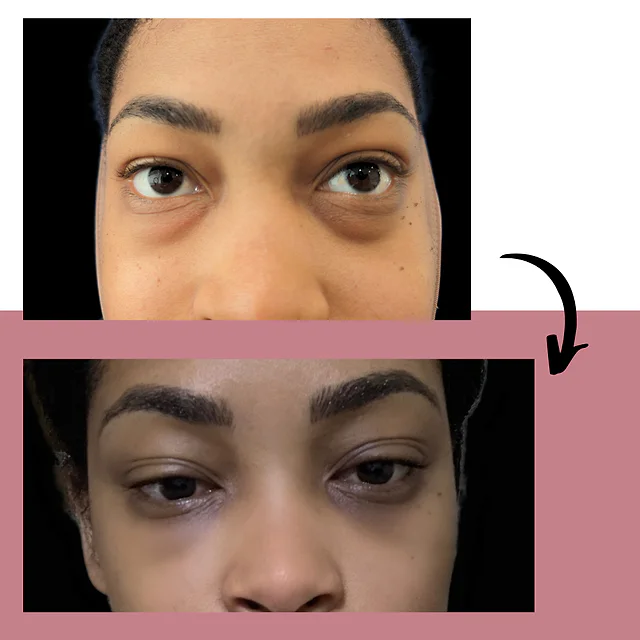 Caso fotográfico de Blefaroplastia, imagen comparativa 3