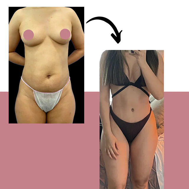 Caso fotográfico de Cirugía Postparto, imagen comparativa 2