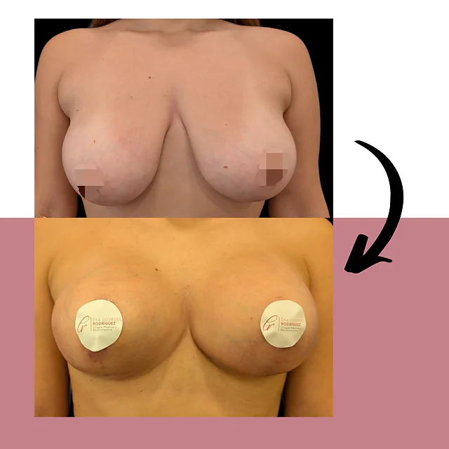 Caso fotográfico de Levantamiento Mamario, imagen comparativa 4