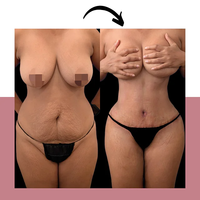 Caso fotográfico de Abdominoplastia, imagen comparativa 4
