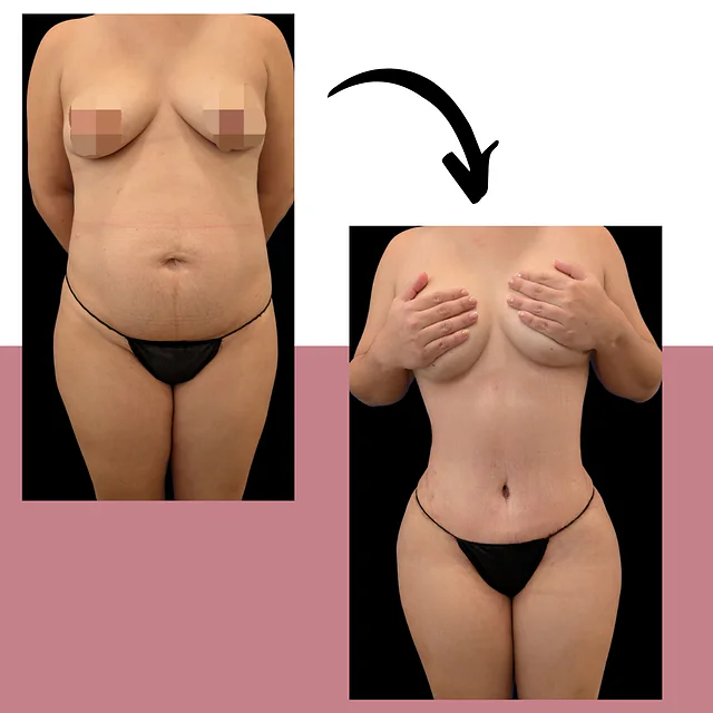 Caso fotográfico de Abdominoplastia, imagen comparativa 1