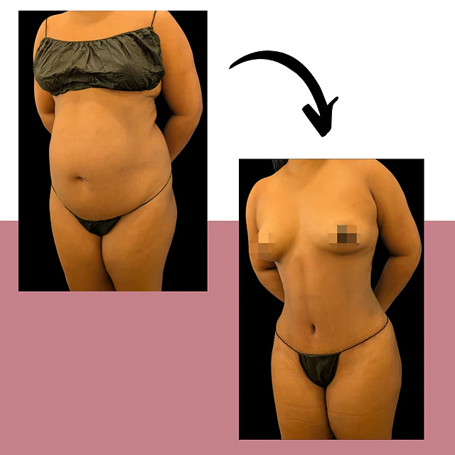 Caso fotográfico de Abdominoplastia, imagen comparativa 2