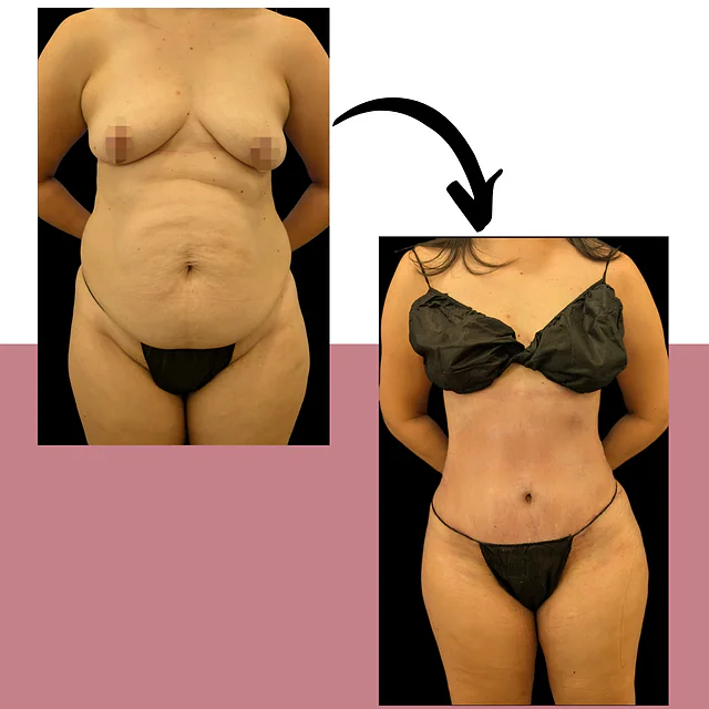 Caso fotográfico de Abdominoplastia, imagen comparativa 3