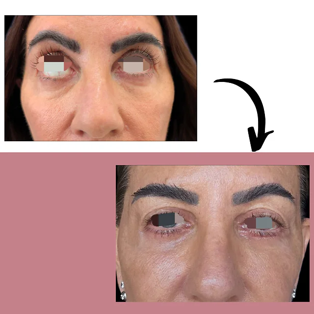 Caso fotográfico de Blefaroplastia, imagen comparativa 1