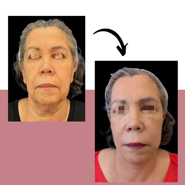 Caso fotográfico de Lifting Facial, imagen comparativa 1
